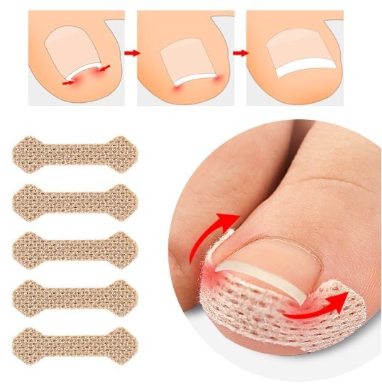 新品☆巻き爪・陥入爪用テーピング 痛み軽減・予防に 10枚付シート5枚(50回分)☆送料無料 拍卖