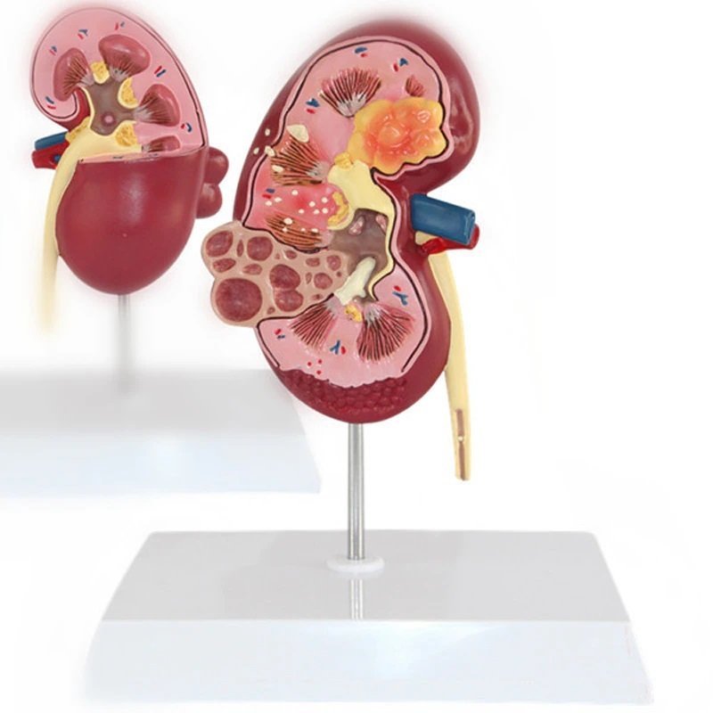PYD964★フルサイズ 完成品 模型 解剖学 人間 腎臓 病変的 モデル ■ 解剖学 学校 模型 病院 教材 医療教育学習 用品 拍卖