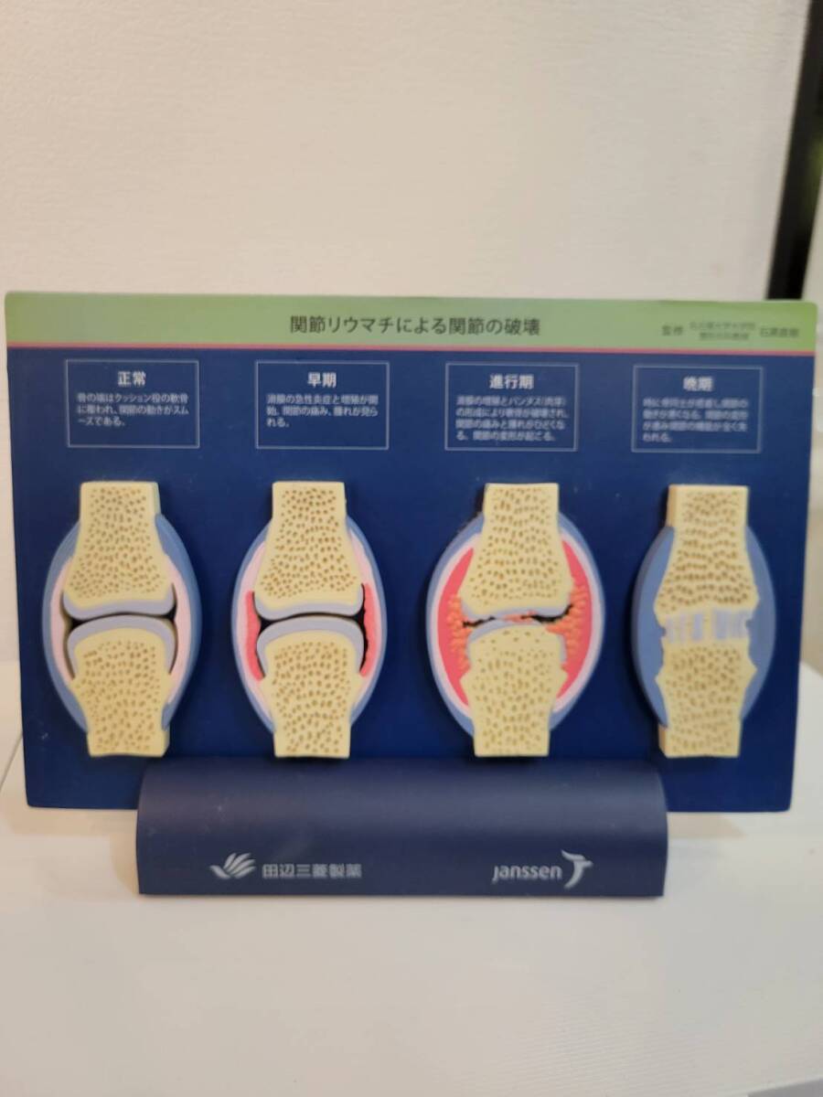 関節リウマチによる関節の破壊パネル