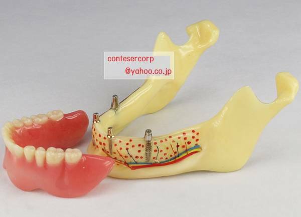 cc高級歯列模型 下顎 インプラントオーバーデンチャー 総義歯